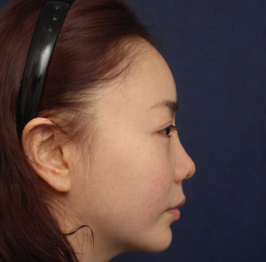 Before/After Image